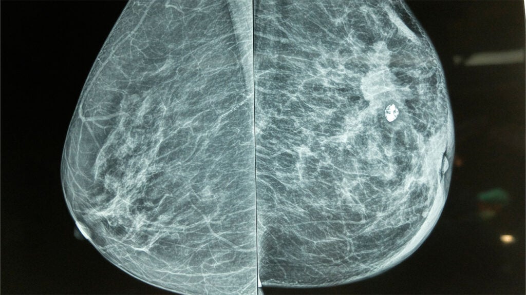 Tina Knowles' Missed Mammogram Leads To Breast Cancer Diagnosis: A Wake-Up Call Tina Knowles' Missed Mammogram Leads To Breast Cancer Diagnosis: A Wake-Up Call